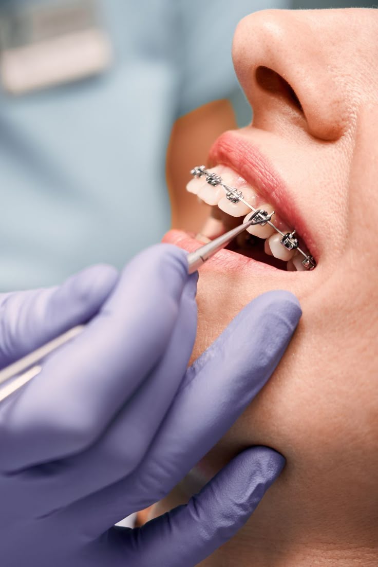 Orthodontic braces